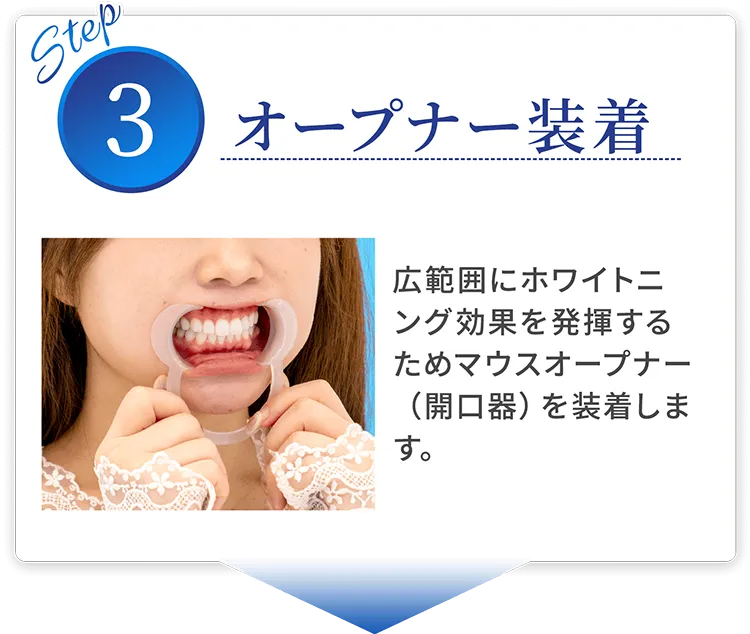 step03 オープナー装着 広範囲にホワイトニング効果を発揮するためマウスオープナー(開口器)を装着します。